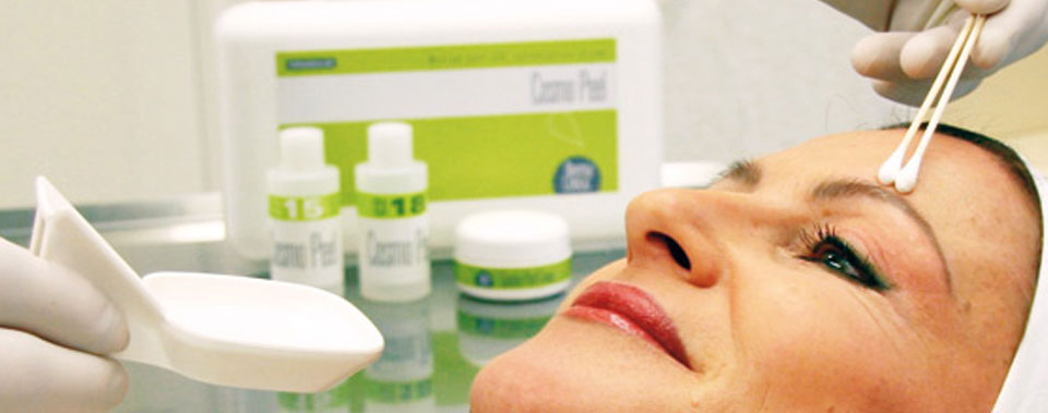chemical-peel